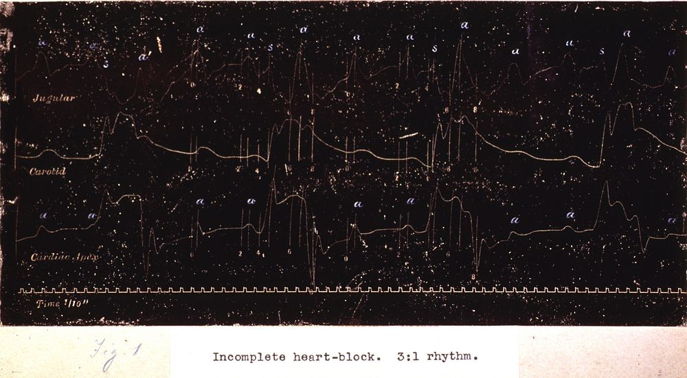 Electrocardiography: Graphs: Incomplete heart block.An early electrocardiograph showing an incomplete heart block. Original…