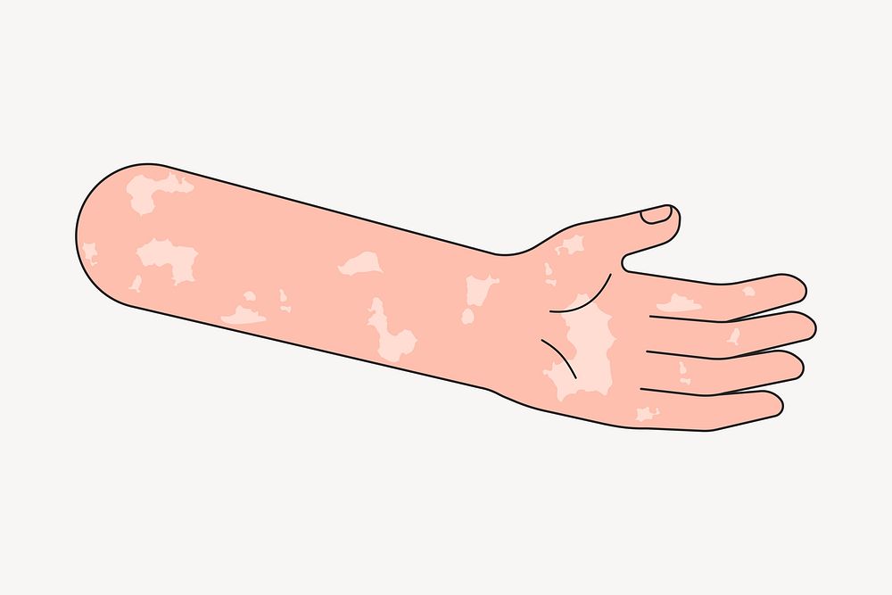 Vitiligo arm hand, body part flat collage element vector