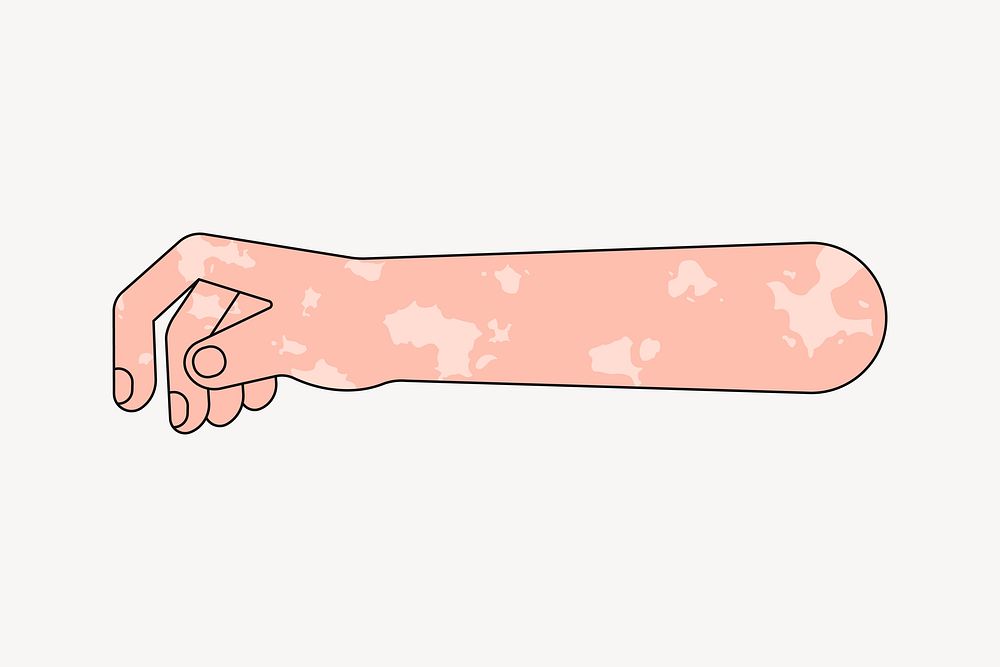 Vitiligo hand arm, gesture flat collage element vector