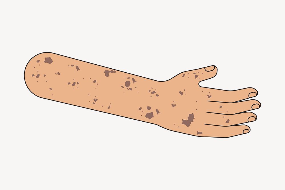 Vitiligo arm hand, body part flat illustration