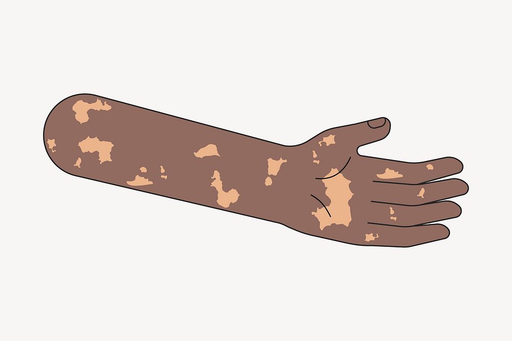 Black vitiligo hand, body part flat illustration