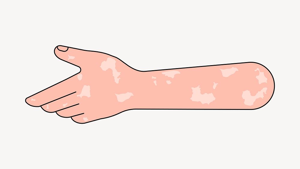 Reaching vitiligo hand, gesture illustration