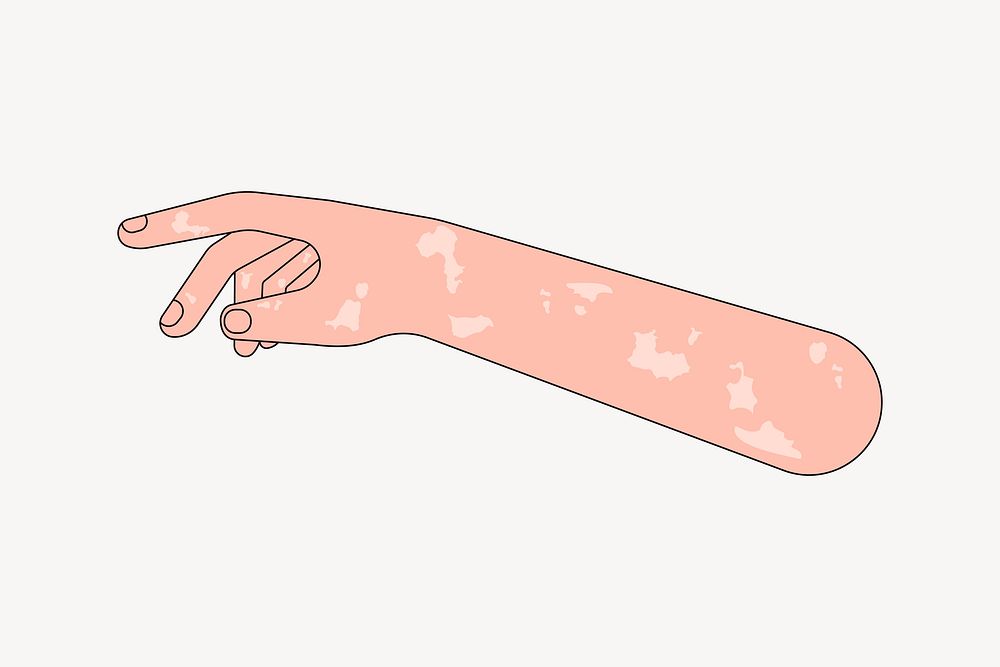 Vitiligo arm hand, body part | Free Photo - rawpixel