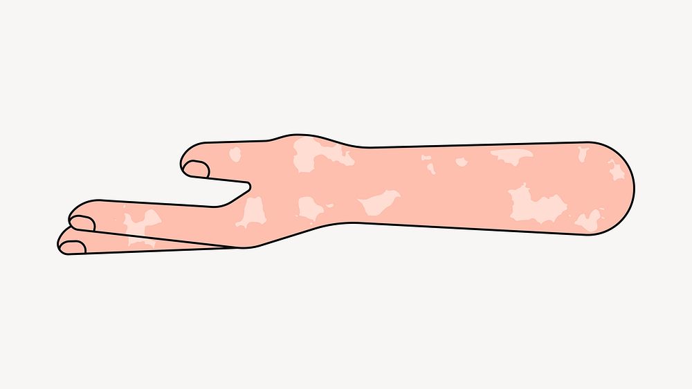 Vitiligo helping hand gesture, flat illustration