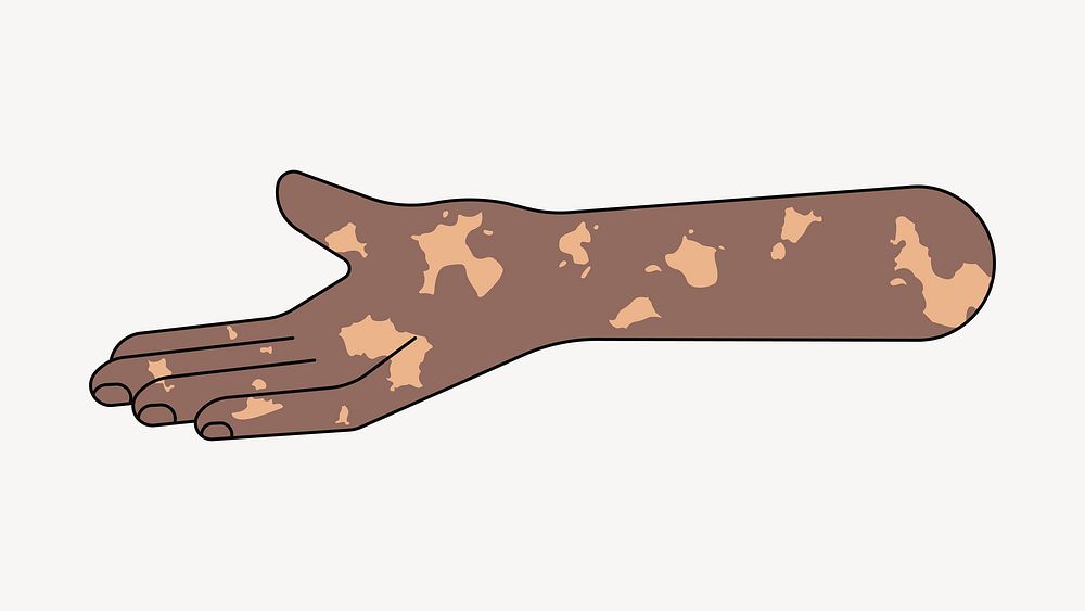 Vitiligo helping hand gesture, flat collage element vector