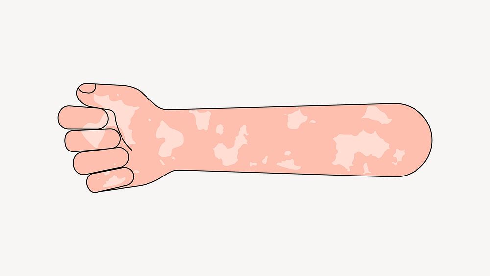 Vitiligo fist arm, gesture flat illustration