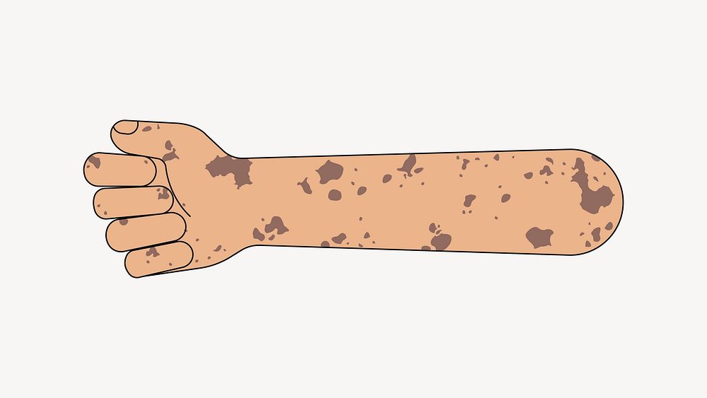 Vitiligo fist arm, gesture flat collage element vector
