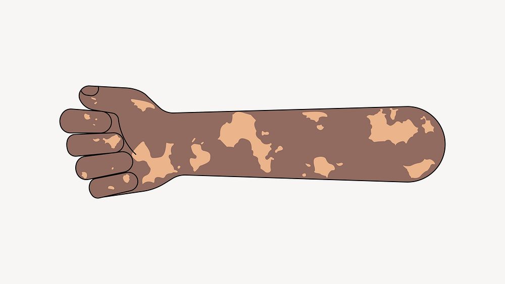 Vitiligo fist arm, gesture flat illustration