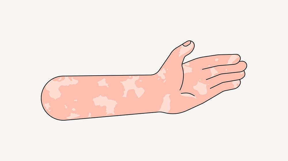 Vitiligo palm hand, gesture flat collage element vector