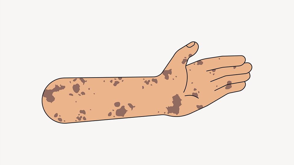 Vitiligo palm hand, gesture flat illustration