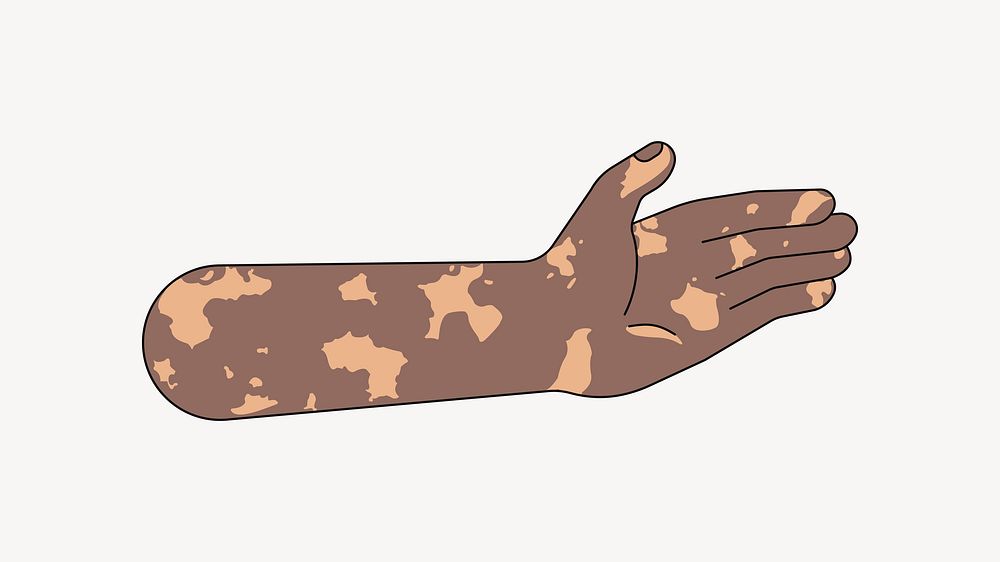 Vitiligo palm hand, gesture flat illustration