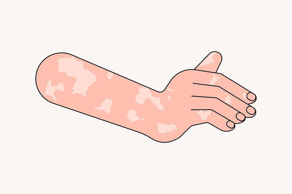 White vitiligo hand gesture, flat collage element vector