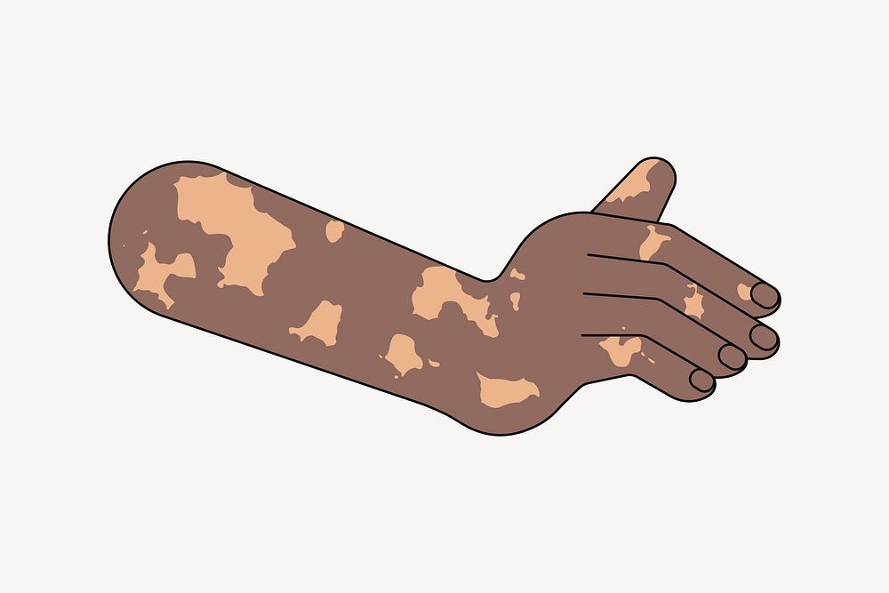 Black vitiligo hand gesture, flat illustration