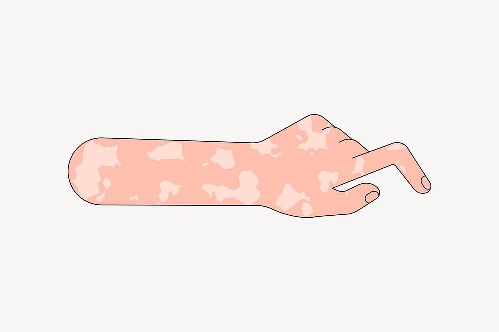 White vitiligo hand gesture, flat illustration
