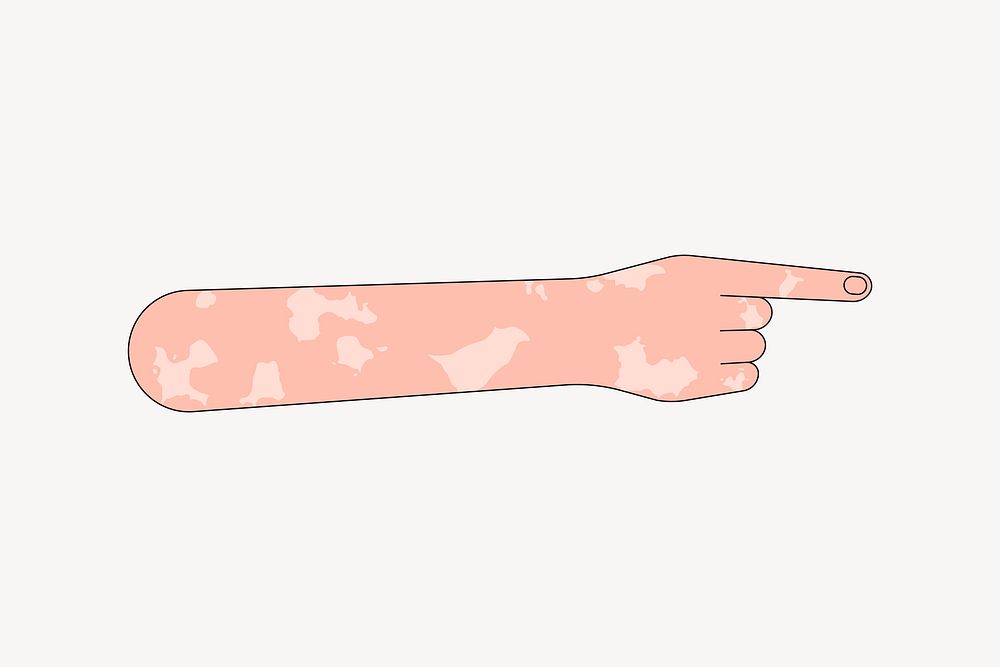 Vitiligo hand pointing finger, gesture illustration