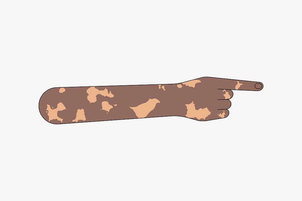 Vitiligo hand pointing finger, gesture illustration