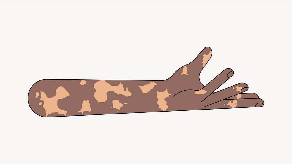 Vitiligo presenting hand gesture, flat collage element vector