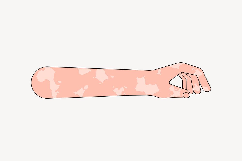 White vitiligo hand gesture, flat collage element vector
