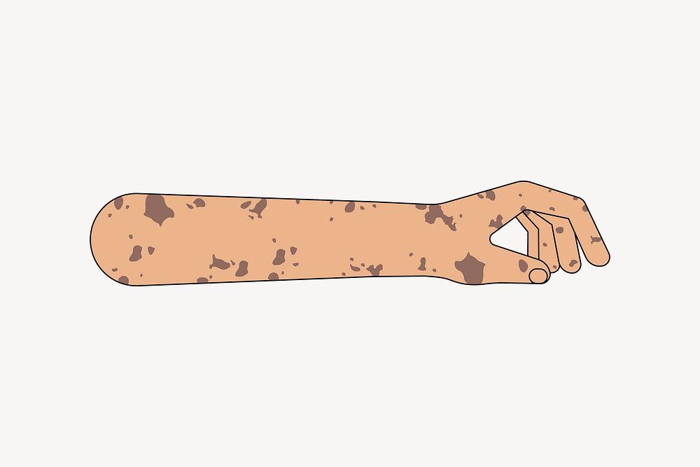 Tanned vitiligo hand gesture, flat illustration