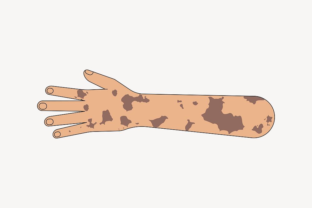 Tanned vitiligo hand gesture, flat collage element vector