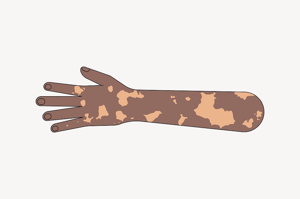 Black vitiligo hand gesture, flat collage element vector