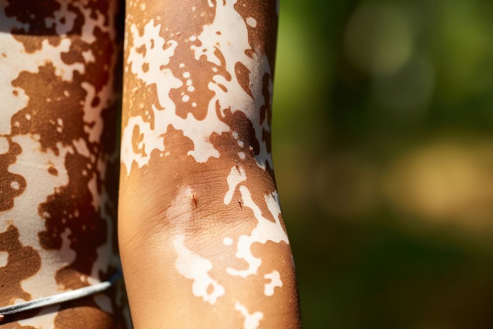Vitiligo arm. AI generated Image by rawpixel.