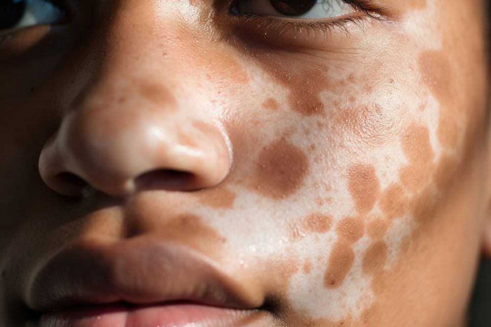 Woman's face with vitiligo skin, closeup. AI generated Image by rawpixel.