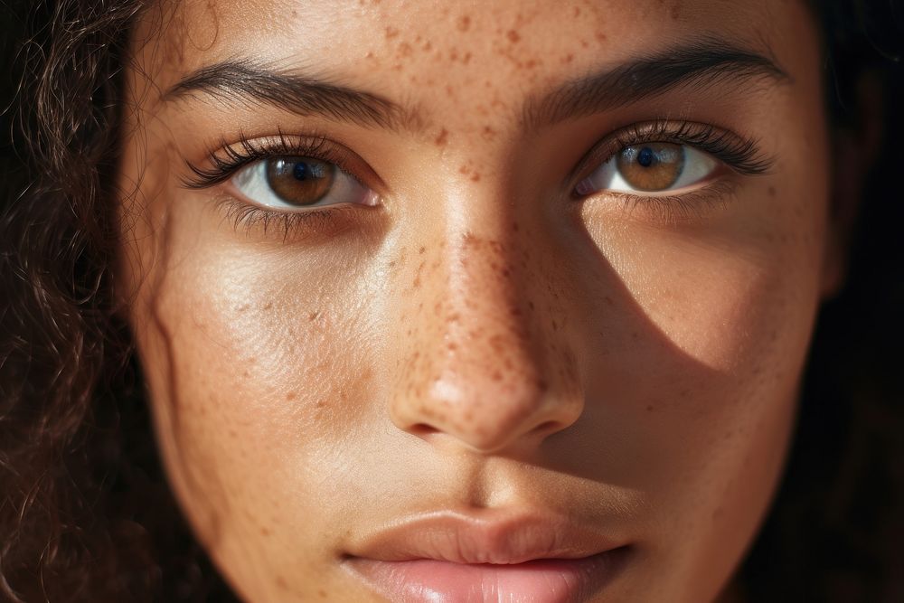 Skin freckle adult woman. 