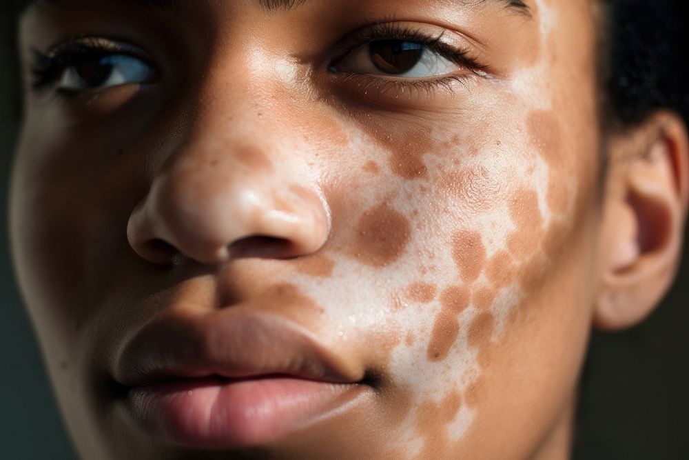 Woman's face with vitiligo skin, closeup. 