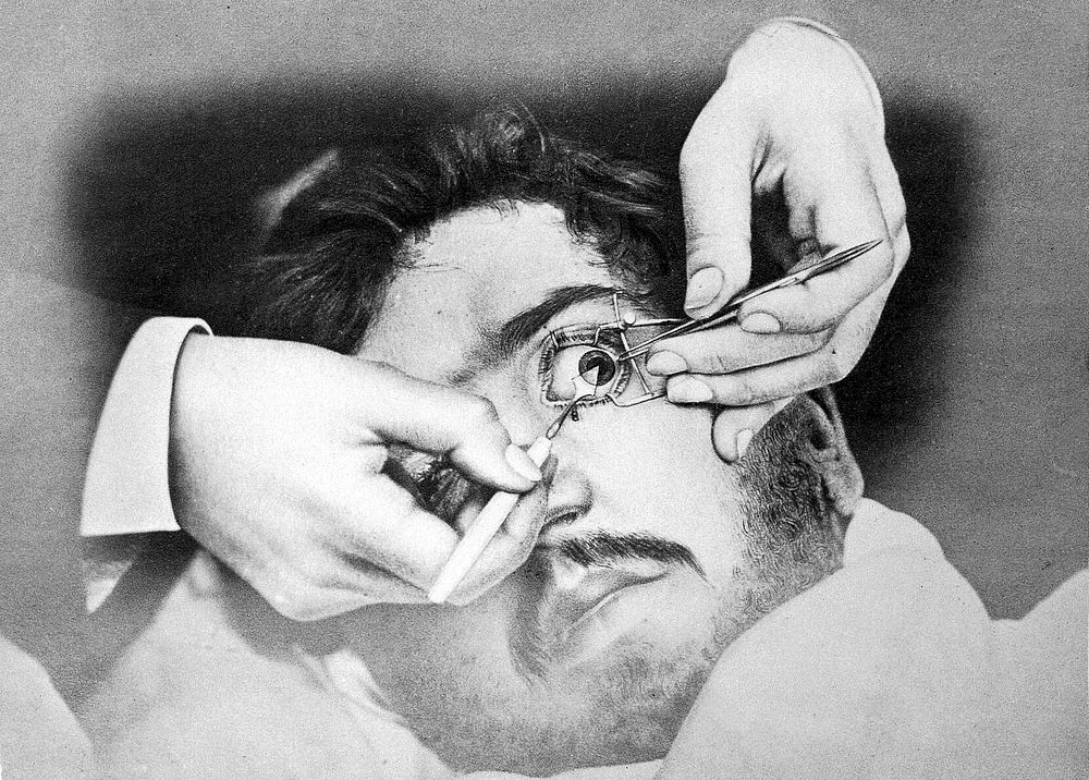 Photo: 'discision de la cataracte'.