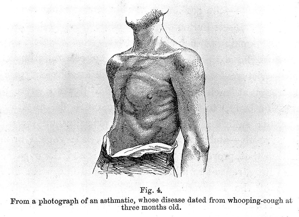 H. H. Salter, On asthma: chest of an asthmatic