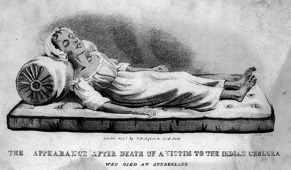 A dead victim of cholera at Sunderland in 1832. Coloured lithograph attributed to J.W. Gear.