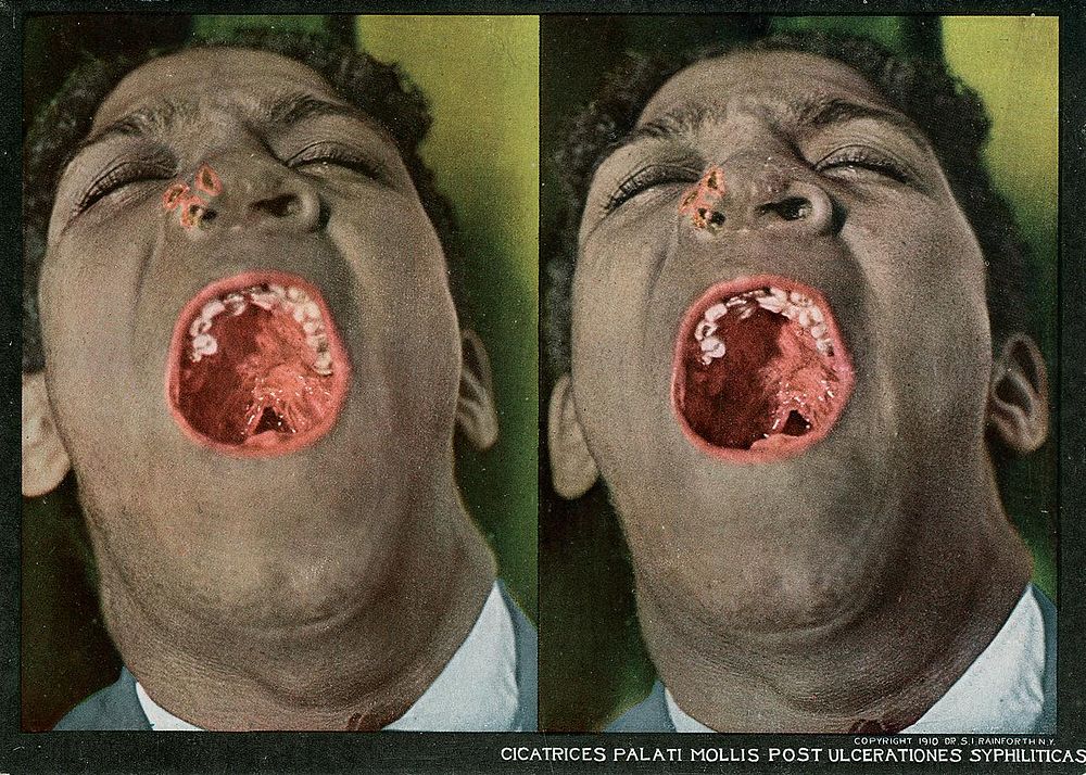 Cicatrices palati mollis post ulcerationes syphiliticas. Stereographies of a man with his mouth wide open to show a…