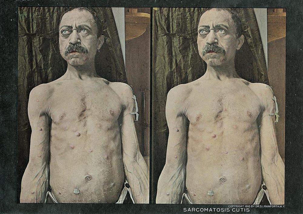 Sarcomatosis cutis. Stereographies of a shirtless man with nodes caused by sarcoma all over his chest. Stereoscopic skin…
