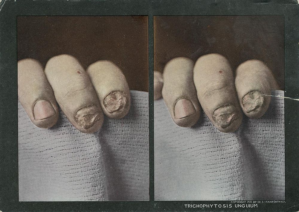 Trichophytosis unguium. Stereographies of 3 fingers with nail infections by ringworms. Stereoscopic skin clinic. Original…