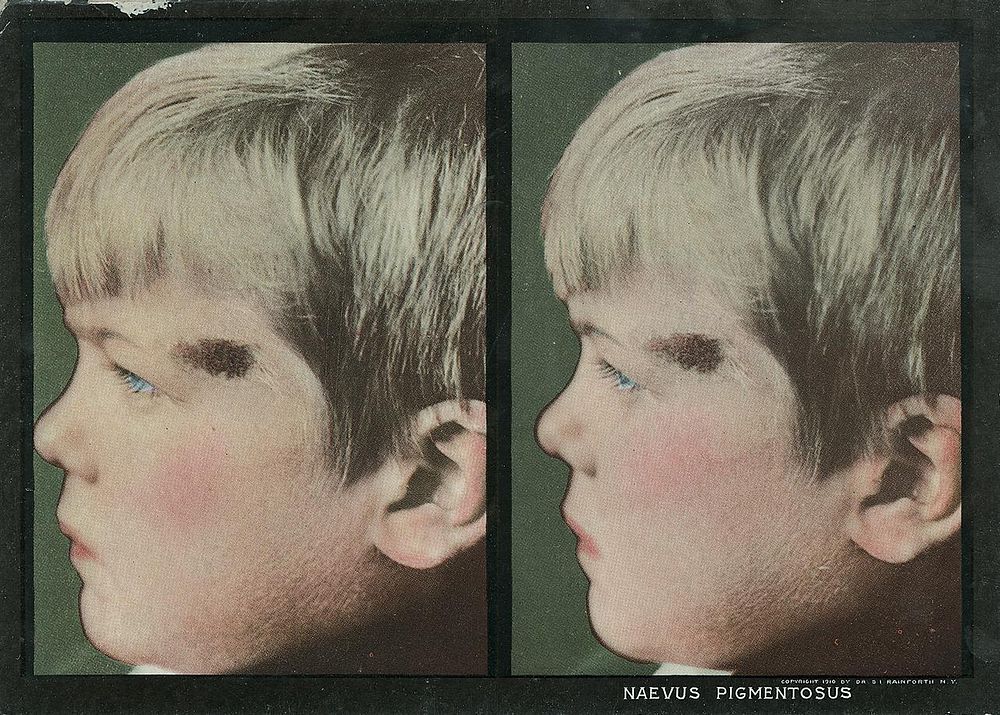 Naevus pigmentosus. Stereographies of a boy's side view with a pigmentary mole by his left eye. Stereoscopic skin clinic.…