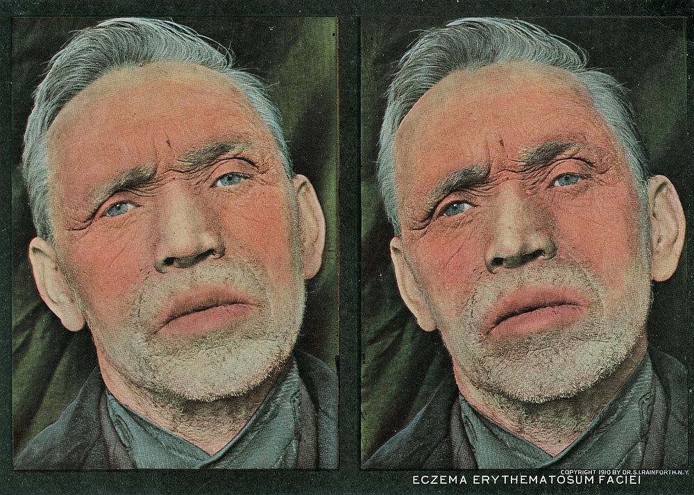 Eczema erythematosum faciei. Stereographies of a man's face with a chronic rash, the excoriations caused by scratching and…