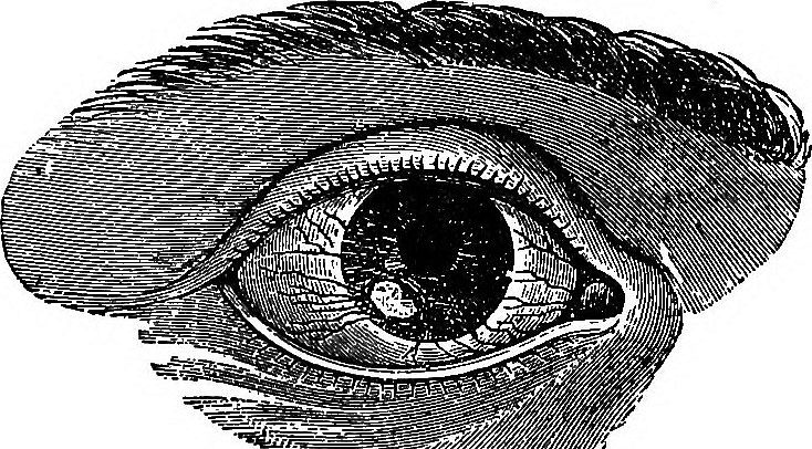 Fig. 34. Phlyctenular Keratitis is characterized by phlyc- tenules in the superficial layers of the coraea like those in…