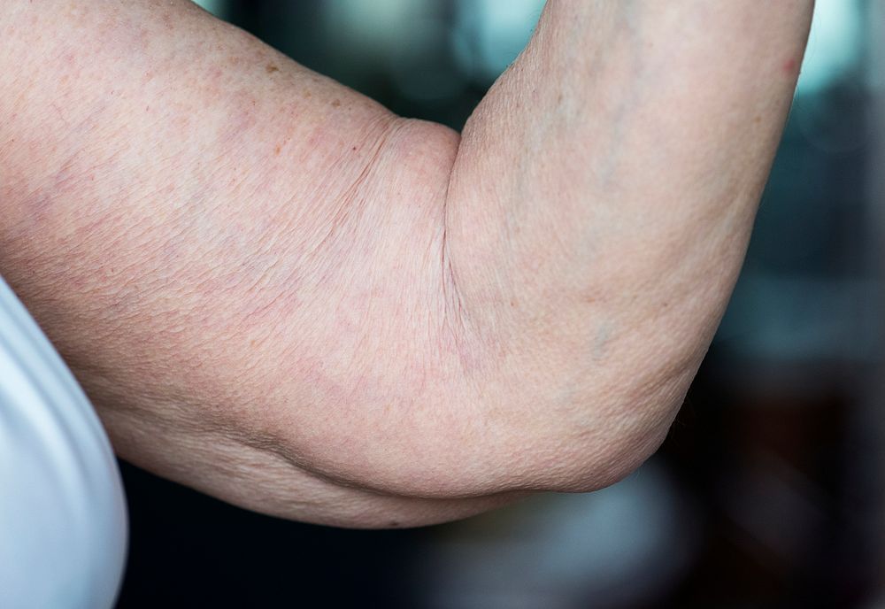 Closeup of loose elderly arm