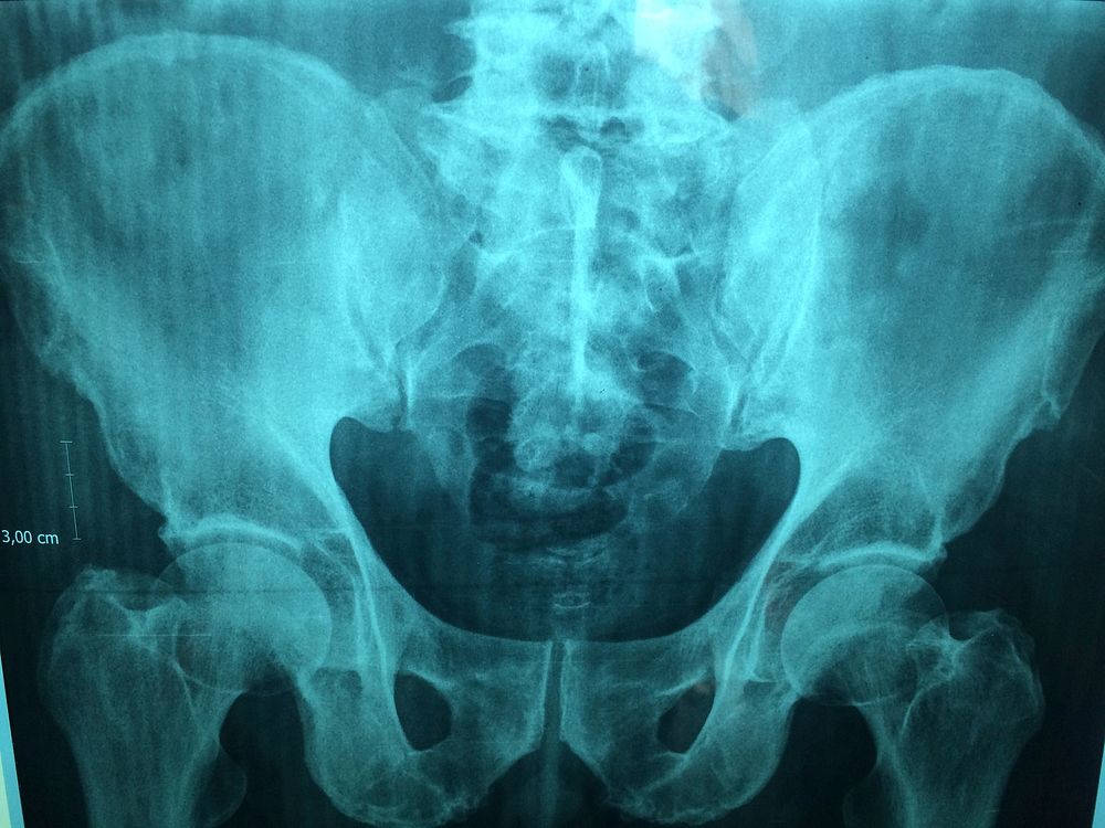 Xray scan of hips. Free public domain CC0 image.