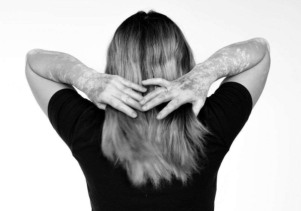 Rear view of woman showing her skin disorder