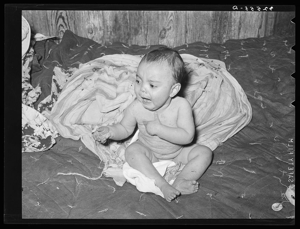 Mexican baby with impetigo. Crystal City, Texas by Russell Lee