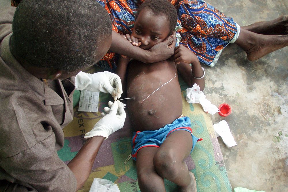 An infant diagnosed with having a Guinea worm disease (GWD). Original image sourced from US Government department: Public…