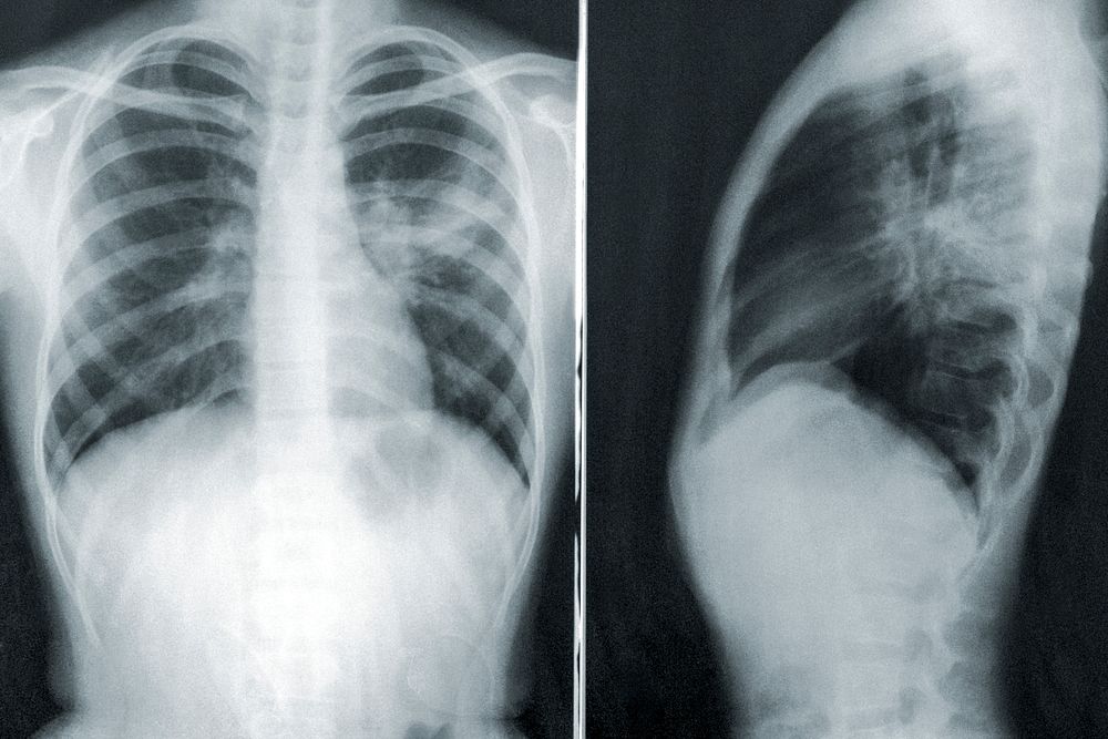 Two chest x-rays in the case of a child with a case of mycoplasma pneumonia. Original image sourced from US Government…