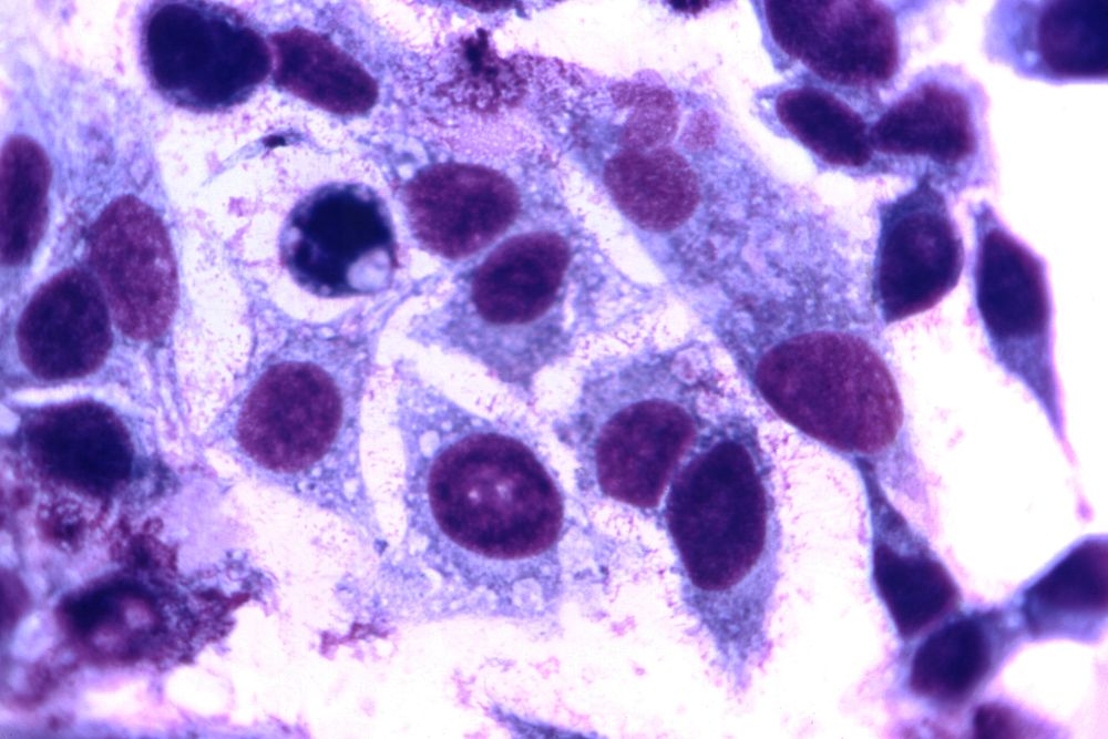 Photomicrograph of Giemsa stained lung tissue. Original image sourced from US Government department: Public Health Image…