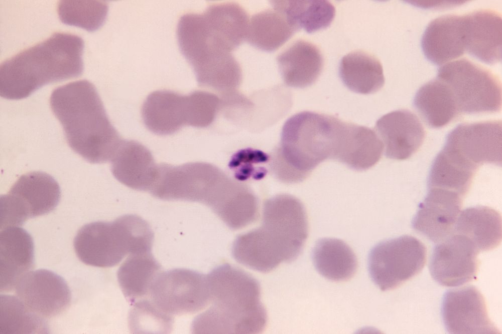 A 1125X photomicrograph magnification of a Giemsa stained, thin film blood smear, revealed a mature, Plasmodium malariae…