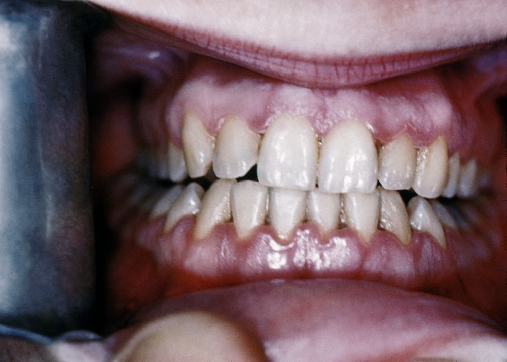 An example of acute necrotizing ulcerative gingivitis, also known as trench mouth. Original image sourced from US Government…