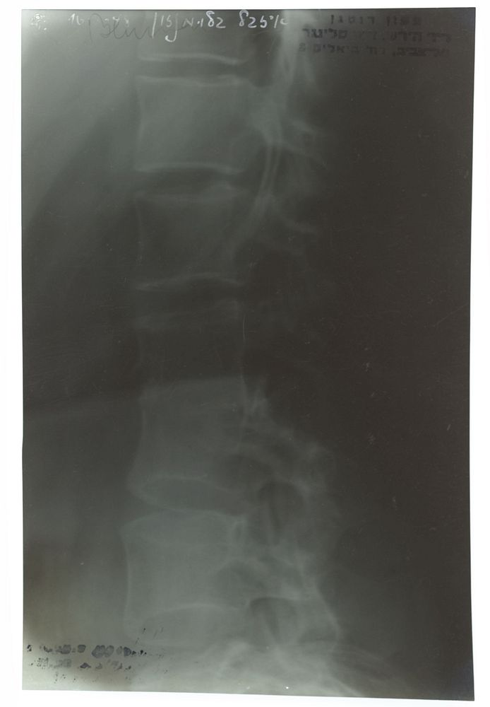 Röntgenfoto van de met TBC geïnfecteerde ruggenwervel van Isabel Wachenheimer, gedateerd op 16 juni 1948 (1948) by anonymous