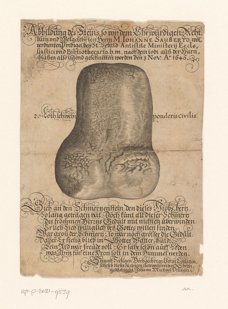 Galsteen verwijderd uit blaas van Johann Saubert op 3 november 1646 (1646 - 1648) by anonymous and Johann Michael Dilherr