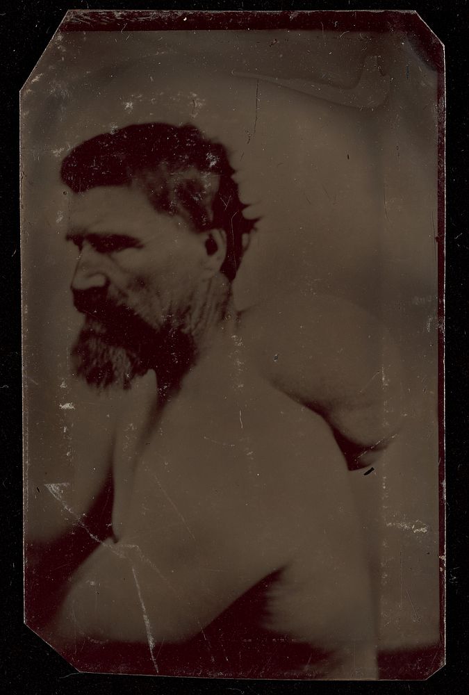 Portrait of a Bearded Man with Abnormal Hump Growth on Back